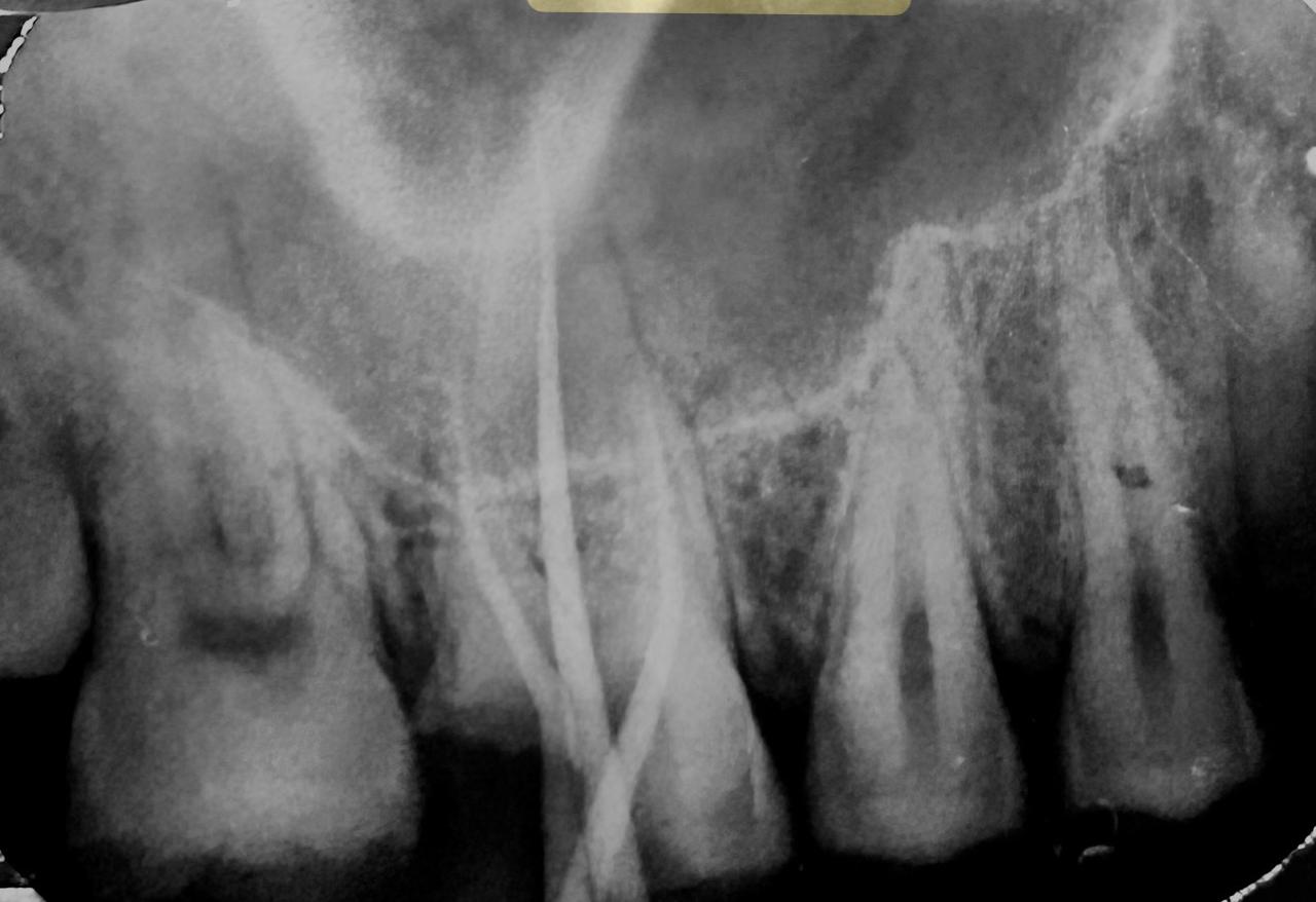 Dental X-ray for root canal treatment